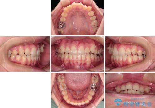 八重歯を確実に改善 補助装置を併用したインビザライン矯正治療の治療中