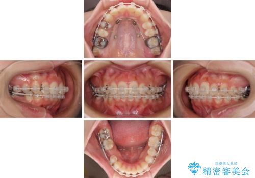 欠損した歯と前に飛び出した前歯　インプラント治療を併用したワイヤー矯正治療の治療中