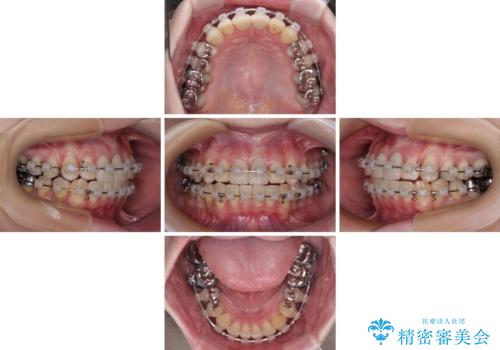 気になる前歯 ワイヤー矯正とセラミック治療の治療中