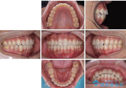 目立たない装置でデコボコを改善　ハーフリンガルによる矯正治療の治療後