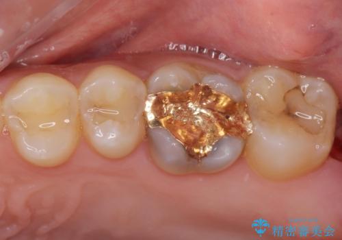 金の詰め物の中にある虫歯を除去してセラミック治療