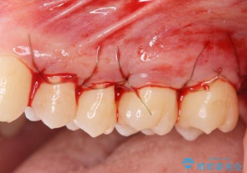 [ 歯周病 ]  歯槽骨の再生治療で歯を残すの治療中