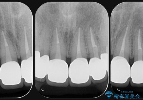 歯周外科を行い、歯ぐきの状態を整えた前歯セラミック治療の治療後