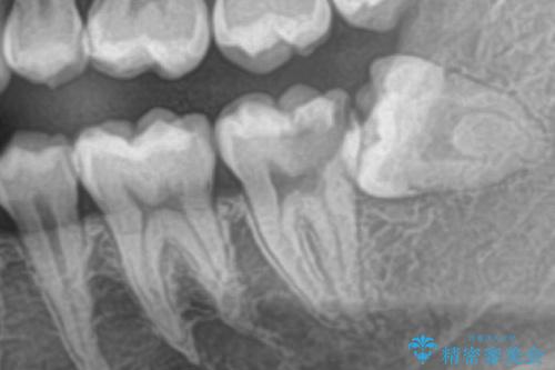 左奥歯が痛い。(親知らず抜歯 ジルコニアクラウン)の治療前