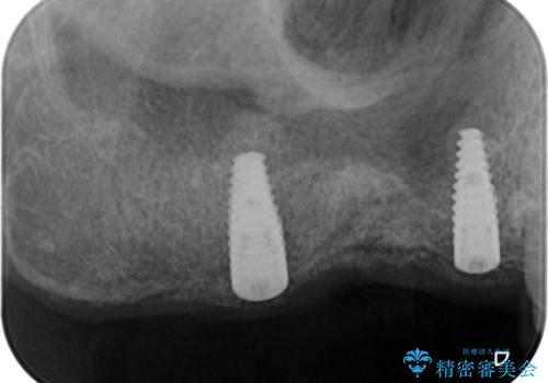 骨の造成を伴う奥歯のインプラント治療の治療中
