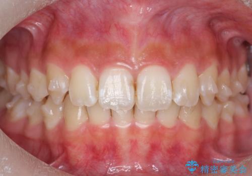 前歯の並び インビザライン 非抜歯で 深いかみ合わせの治療の治療中
