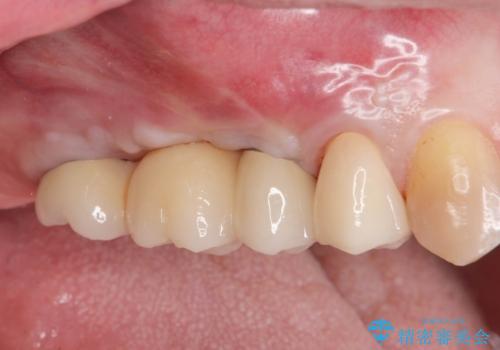 骨の造成を伴う奥歯のインプラント治療の症例 治療後