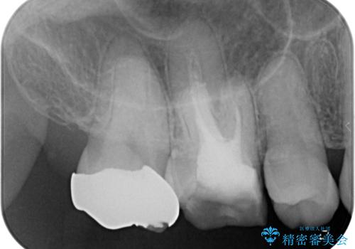 金属の詰め物が取れた。セラミックを入れたい! オールセラミッククラウンの治療前