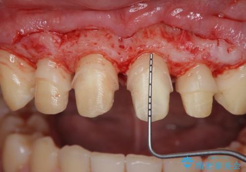 歯周外科を行い、歯ぐきの状態を整えた前歯セラミック治療の治療中