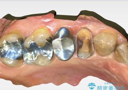 できるだけ歯質を残した1day治療 セラミックインレーの治療中