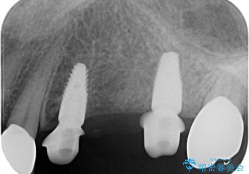 複数の奥歯の欠損　インプラントによる咬合機能回復の治療中