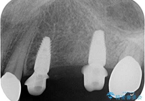複数の奥歯の欠損 インプラントによる咬合機能回復の治療中