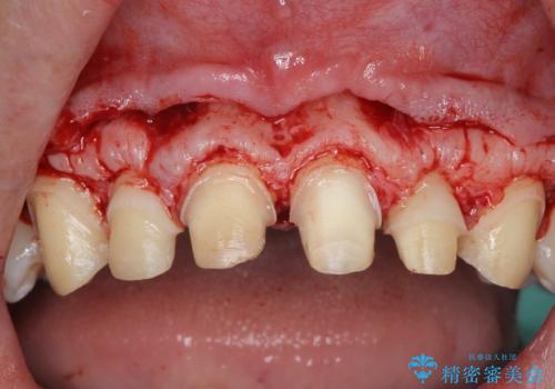 歯周外科を行い、歯ぐきの状態を整えた前歯セラミック治療の治療中