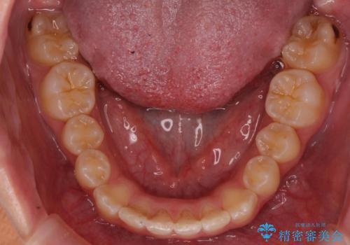 前歯の並び インビザライン 非抜歯で 深いかみ合わせの治療の治療後