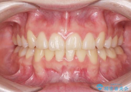 [ 八重歯を治す ]   小臼歯4本抜歯 マルチブラケット矯正の症例 治療後