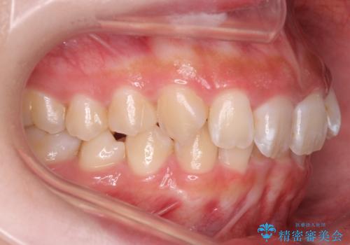 前歯の並び インビザライン 非抜歯で 深いかみ合わせの治療の治療前
