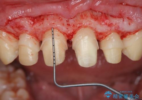 歯周外科を行い、歯ぐきの状態を整えた前歯セラミック治療の治療中