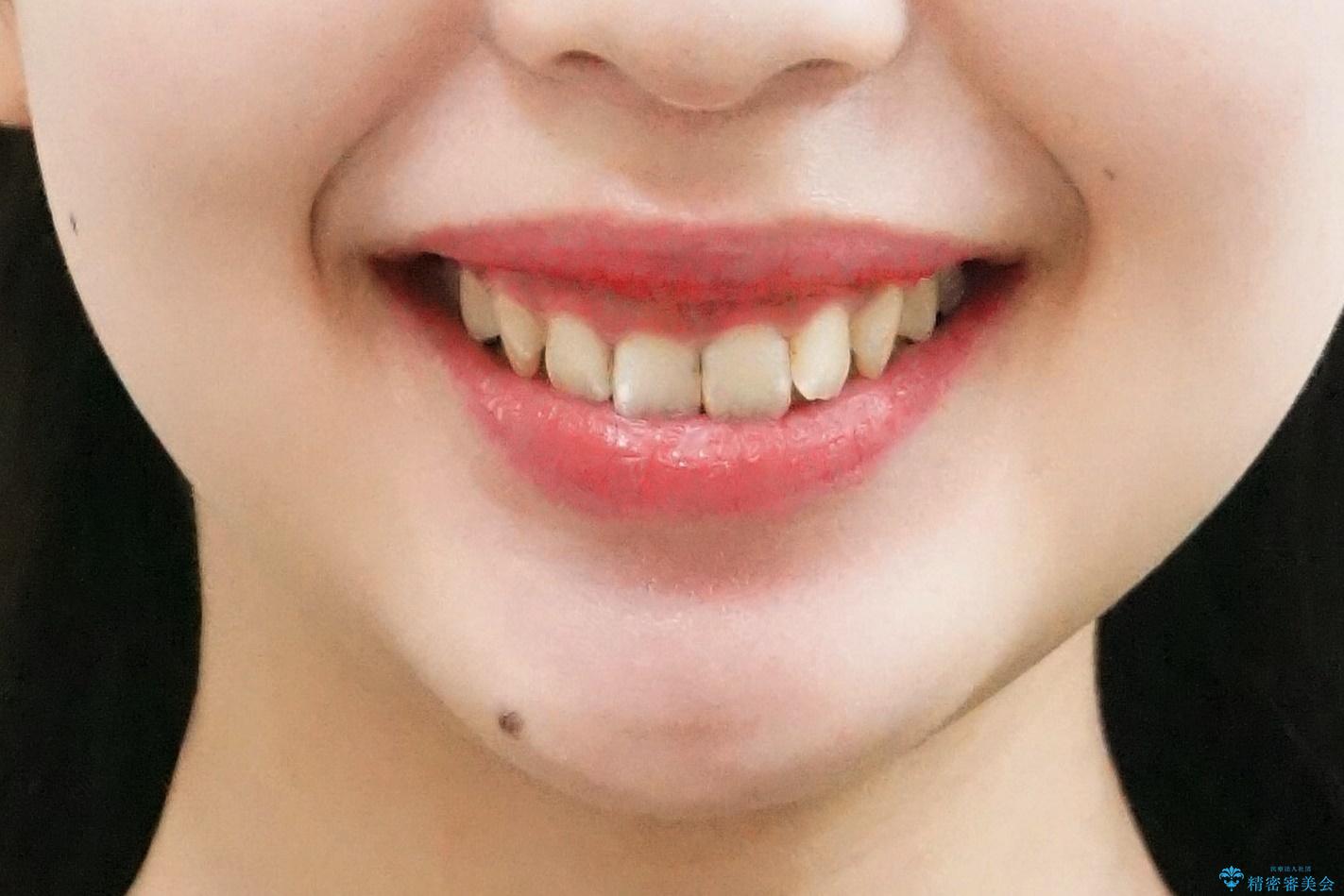 前歯の並び インビザライン 非抜歯で 深いかみ合わせの治療の治療前(顔貌)