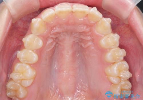 前歯の並び インビザライン 非抜歯で 深いかみ合わせの治療の治療中