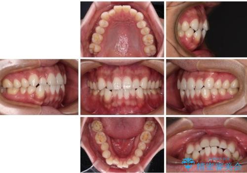 目立たない装置でデコボコを改善　ハーフリンガルによる矯正治療の治療前