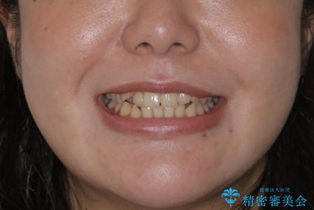 八重歯とクロスバイト:インビザライン治療の治療前(顔貌)