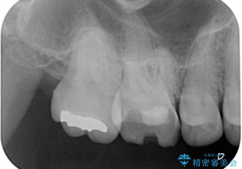 歯が割れた オールセラミッククラウンの治療前