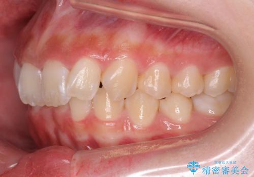 前歯の並び インビザライン 非抜歯で 深いかみ合わせの治療の治療前