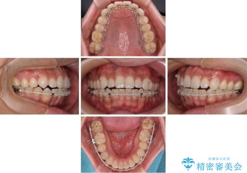 目立たない装置でデコボコを改善　ハーフリンガルによる矯正治療の治療中