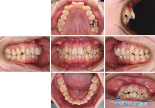 飛び出した上顎前歯と上下のデコボコ　片顎の抜歯によるワイヤー矯正の治療前