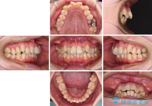 飛び出した上顎前歯と上下のデコボコ 片顎の抜歯によるワイヤー矯正の治療前