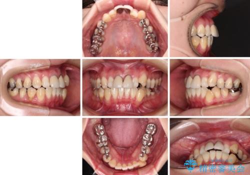 気になる前歯 ワイヤー矯正とセラミック治療の治療前