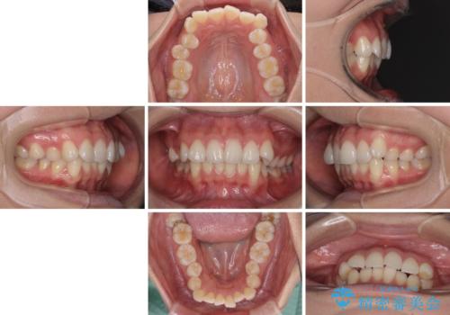 前歯のデコボコを解消 インビザラインの矯正治療の治療前