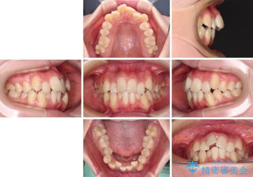 デコボコと出っ歯 抜歯矯正でスッキリとした口元にの治療前