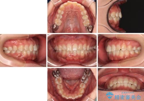 インビザライン・モデレートを用いて気になる前歯を短期間で矯正治療の治療前