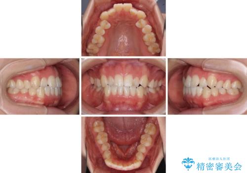閉じにくい口元をワイヤー抜歯矯正でスッキリ改善の治療前