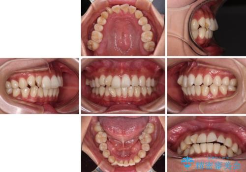 【モニター】上顎前突と奥歯の鋏状咬合 補助装置を用いたインビザライン矯正治療の治療前