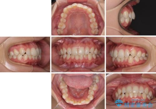 埋もれた奥歯をワイヤーで改善　インビザラインによる矯正治療の治療前