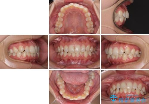 埋もれた奥歯をワイヤーで改善 インビザラインによる矯正治療の治療前