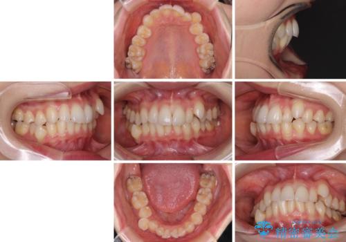 【モニター】顎のゆがみをカムフラージュ　ワイヤー装置の抜歯矯正の治療前