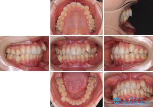 【モニター】顎のゆがみをカムフラージュ ワイヤー装置の抜歯矯正の治療前