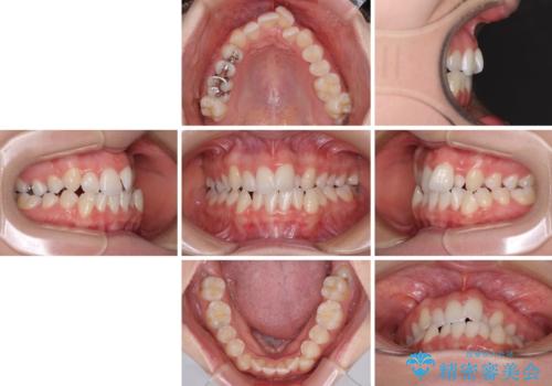骨格的な問題を側方拡大で解決 ワイヤー矯正治療の治療前