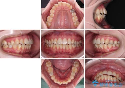 開咬と前方に飛び出した前歯　インビザラインによる矯正治療の治療前