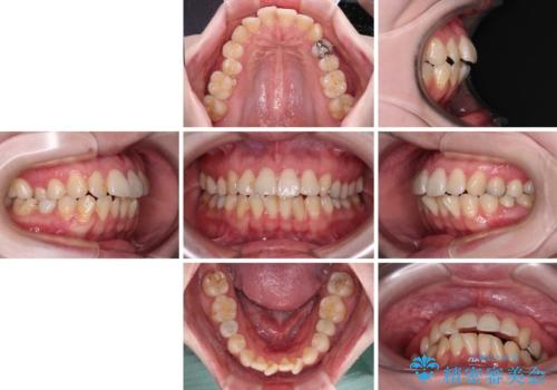 開咬と前方に飛び出した前歯 インビザラインによる矯正治療の治療前