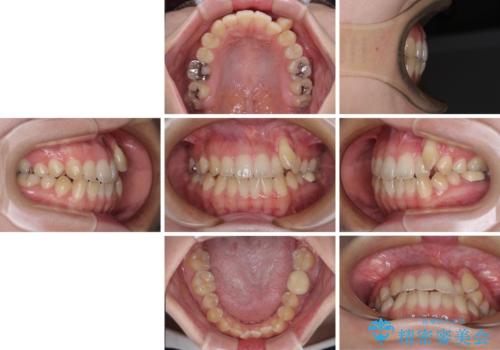 急速拡大装置 狭い上顎骨を拡大してワイヤー装置で八重歯を短期間治療の治療前