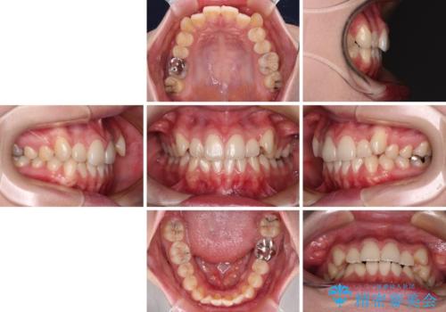 八重歯を確実に改善　補助装置を併用したインビザライン矯正治療の治療前
