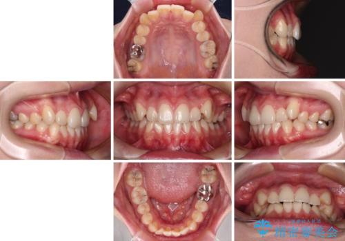 八重歯を確実に改善 補助装置を併用したインビザライン矯正治療の治療前
