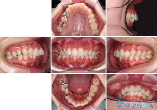 欠損した歯と前に飛び出した前歯　インプラント治療を併用したワイヤー矯正治療の治療前