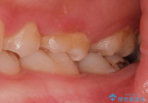 左奥歯が痛い。(親知らず抜歯 ジルコニアクラウン)の治療前