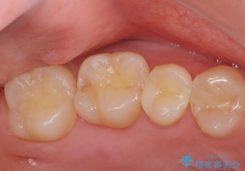虫歯の再発リスクが高い樹脂修復部分をe-maxインレーにの症例 治療前