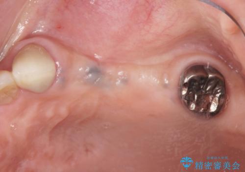 複数の奥歯の欠損　インプラントによる咬合機能回復の治療前